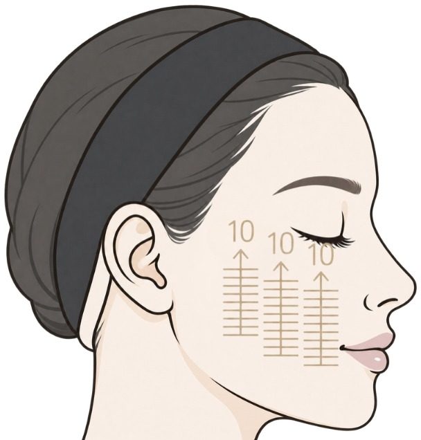 Shot map illustration showing Face-up HIFU placements in upward paths across the cheek