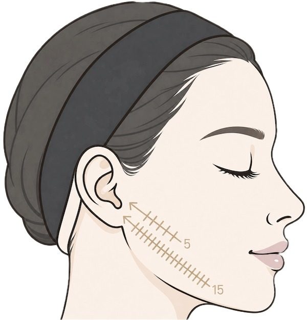 Shot map illustration showing V-up HIFU placements along the jawline towards the ear